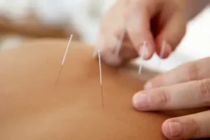 Revitalize Your Well-Being: Acupuncture for Pain Relief in NYC